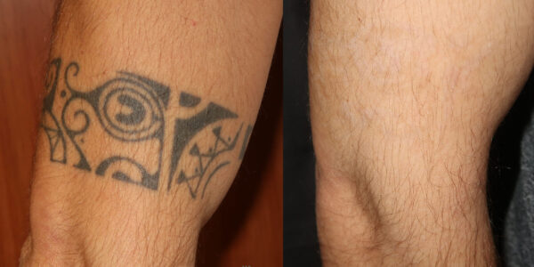 Rimozione tatuaggi coscia dopo 5 sedute