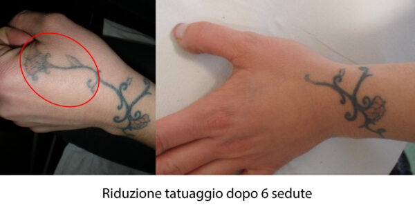riduzione tatuaggio mano