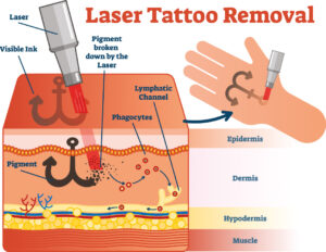 rimuovere il tatuaggio con il laser