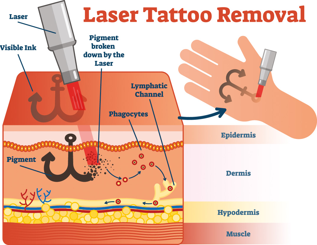 rimuovere il tatuaggio con il laser