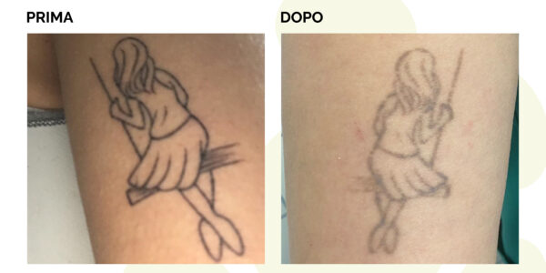 Dopo 2 sedute, trattamento in corso